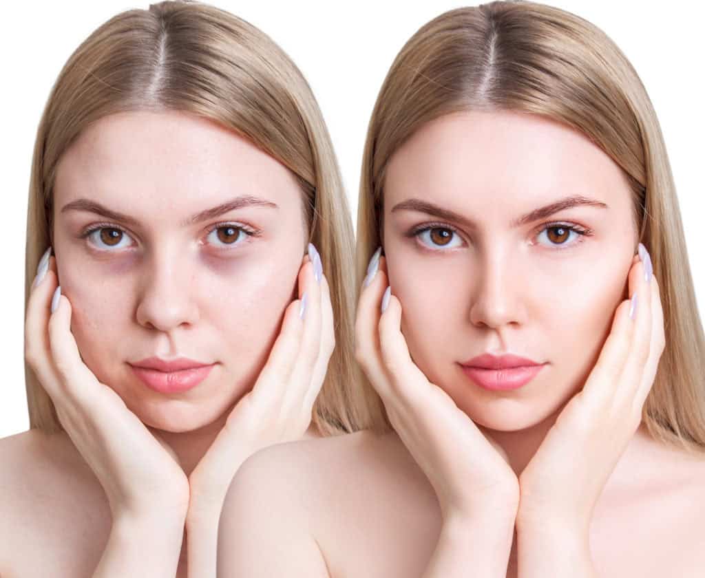 Are Anti-Wrinkle Injections The Same As Botox?